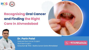 Oral cancer treatment in Ahmedabad